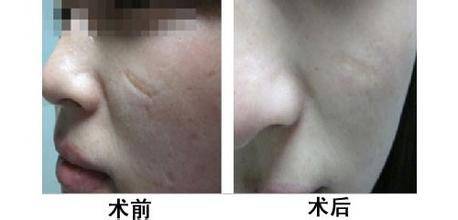 疤痕切除手术