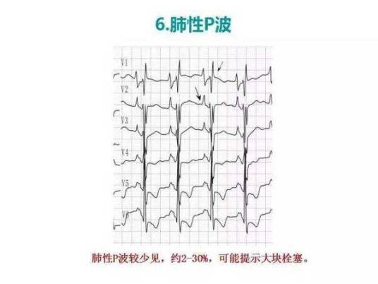 肺性p波