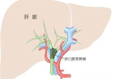 肝门胆管癌