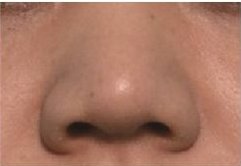 鼻部整形有哪些方法 哪些人适合做鼻部整形