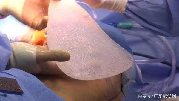 很多年前，男子给自己的后背上安上了一双翅膀，现在状况如何？