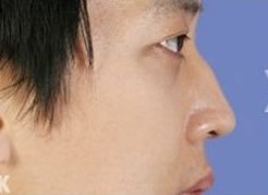 鼻部整形有哪些方法 哪些人适合做鼻部整形