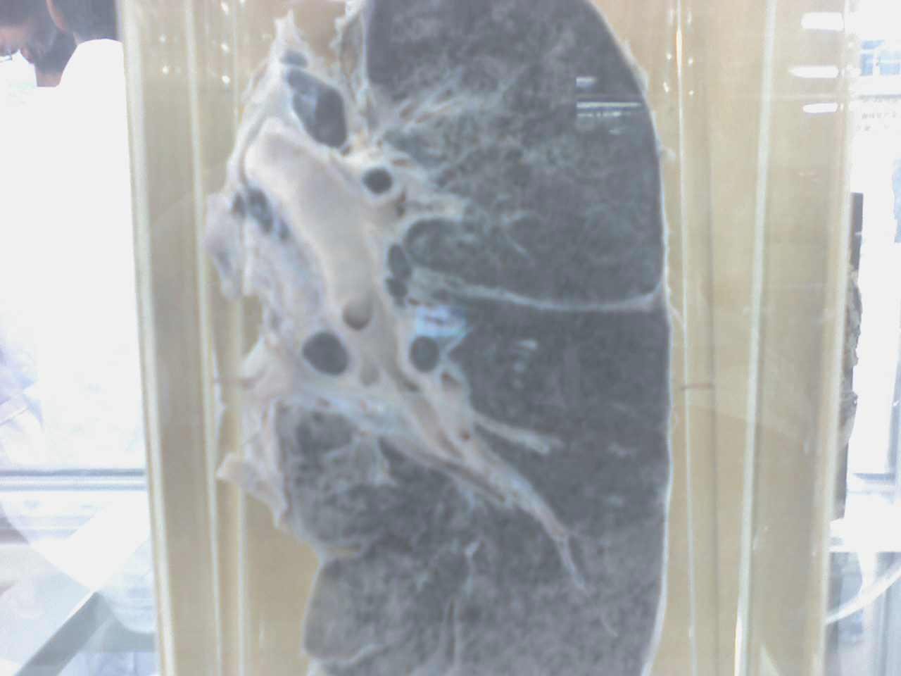 哪里能找到抽烟人的肺的图片啊~要大的