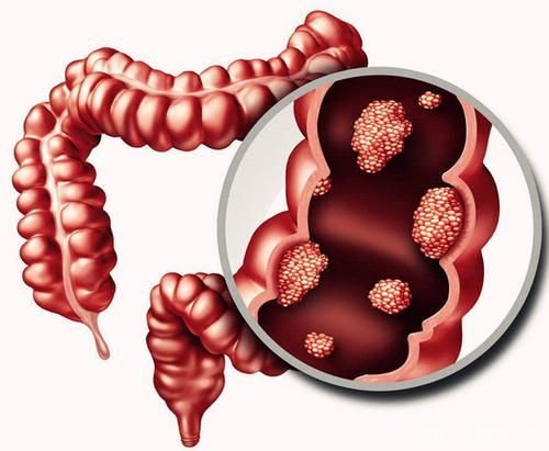 什么情况下需要进行肠镜检查?为什么?