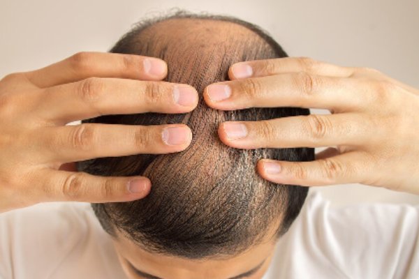 莫言现场回答网友提问脱发问题，你身边的朋友是否出现了脱发的迹象？