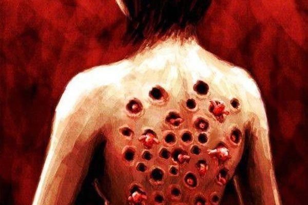 玉米男孩是什么病 寄生虫的故事是真的吗